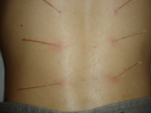 sesión de acupuntura