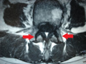 artrosis interapofisaria 3