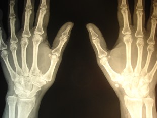 aspecto antes de la RX con las calcificaciones