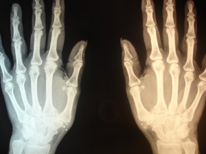 aparente disminución de la calcificación en la mano izquierda
