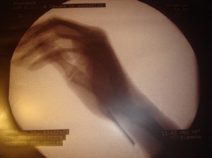 imagen intraoperatoria en la que se puede ver la aguja de implantación