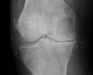 los puntos blancos son los implantes de oro