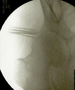 Implantes en cadera E.S.