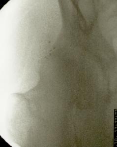 implantes en cadera1 E.S.