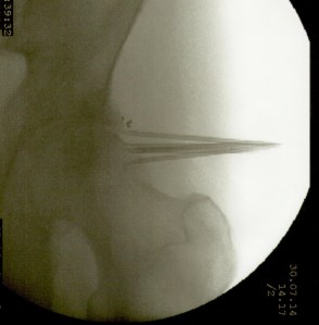 implantes en caderaJ.M.S.DER.jpeg