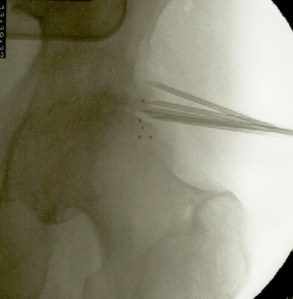 implantes en caderaJ.M.S.izq.