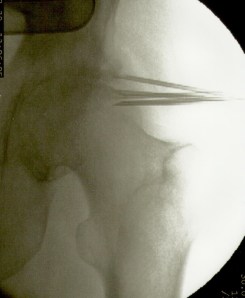 implantes en caderaJ.M.S1.izq..jpeg