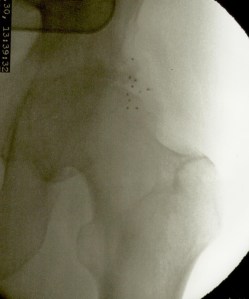 implantes en caderaJ.M.S2.izq..jpeg.jpeg